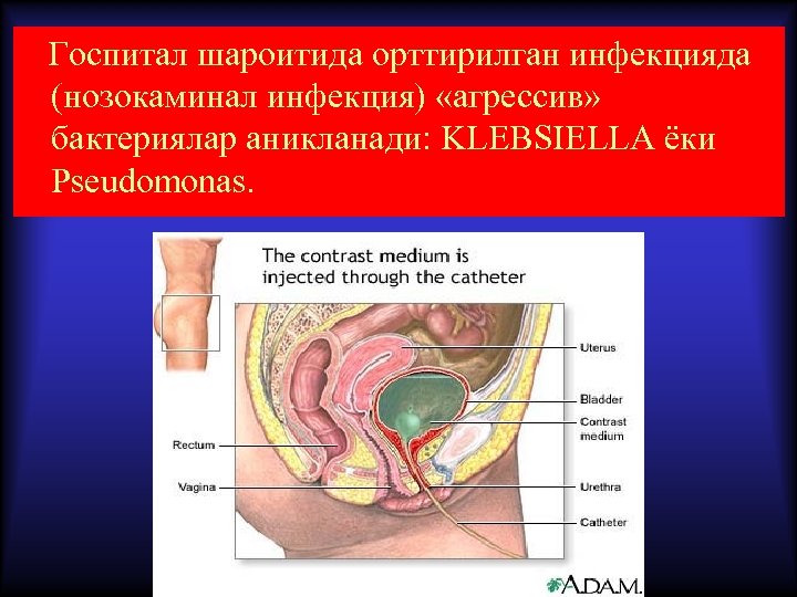  Госпитал шароитида орттирилган инфекцияда (нозокаминал инфекция) «агрессив» бактериялар аникланади: KLEBSIELLA ёки Pseudomonas. 