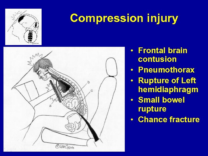 Compression injury • Frontal brain contusion • Pneumothorax • Rupture of Left hemidiaphragm •