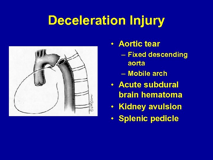 Deceleration Injury • Aortic tear – Fixed descending aorta – Mobile arch • Acute