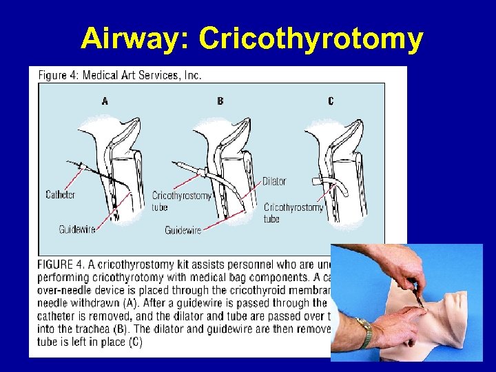 Airway: Cricothyrotomy 