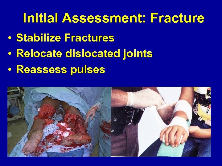 Initial Assessment: Fracture • Stabilize Fractures • Relocate dislocated joints • Reassess pulses 