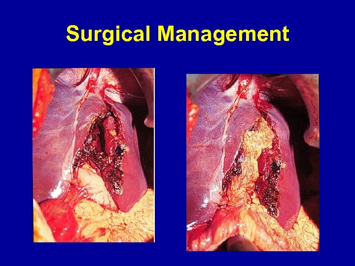 Surgical Management 