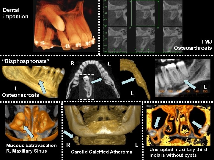 Dental impaction TMJ Osteoarthrosis “Bisphonate” R L L Osteonecrosis Mucous Extravasation R. Maxillary Sinus