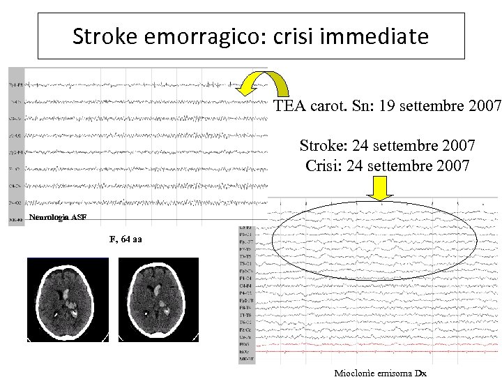 Stroke emorragico: crisi immediate TEA carot. Sn: 19 settembre 2007 Stroke: 24 settembre 2007