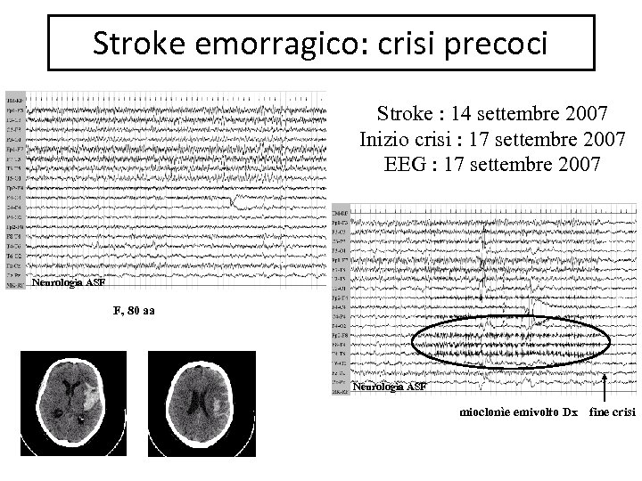 Stroke emorragico: crisi precoci Stroke : 14 settembre 2007 Inizio crisi : 17 settembre