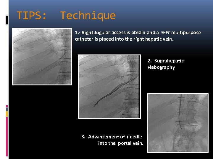 TIPS: Technique 1. - Right Jugular access is obtain and a 5 -Fr multipurpose