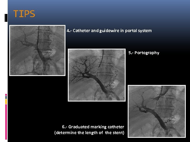 TIPS 4. - Catheter and guidewire in portal system 5. - Portography 6. -