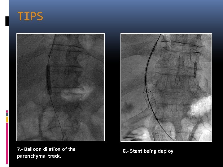 TIPS 7. - Balloon dilation of the parenchyma track. 8. - Stent being deploy