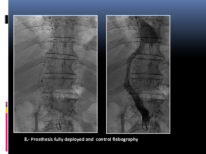 8. - Prosthesis fully deployed and control flebography 