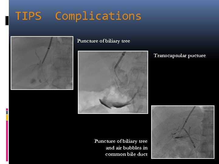 TIPS Complications Puncture of biliary tree Transcapsular pucture Puncture of biliary tree and air