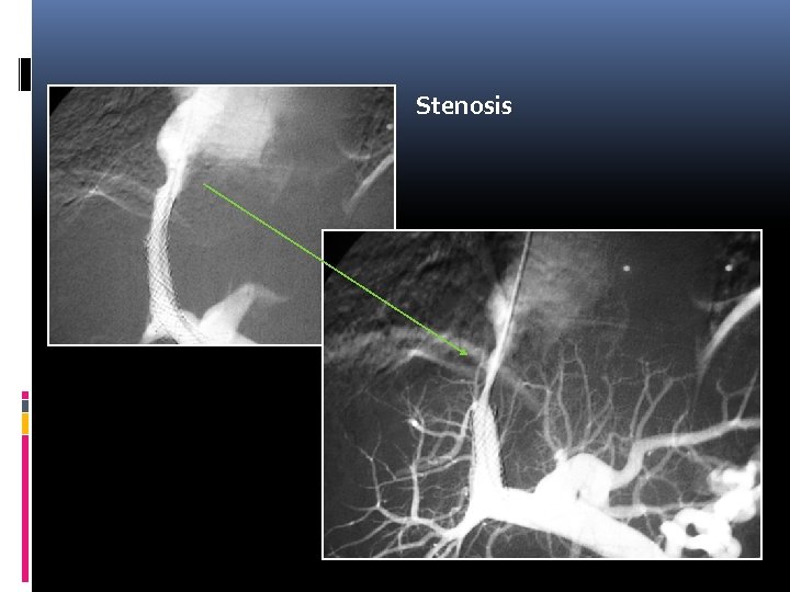 Stenosis 