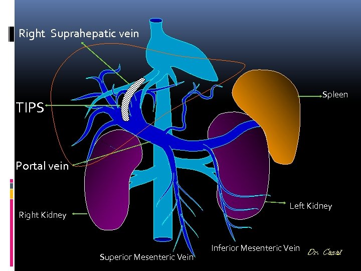 Right Suprahepatic vein Spleen TIPS Portal vein Left Kidney Right Kidney Superior Mesenteric Vein