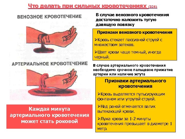 Что делать при сильных кровотечениях (326) В случае венозного кровотечения достаточно наложить тугую давящую