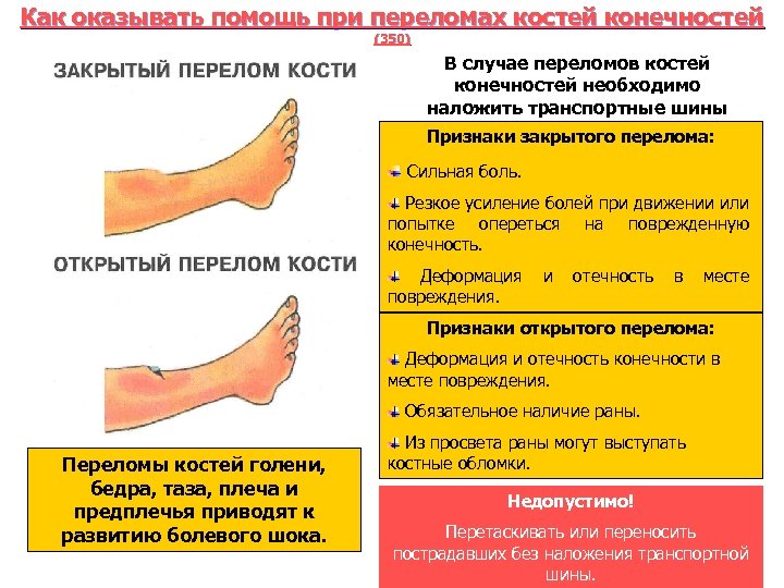 Как оказывать помощь при переломах костей конечностей (350) В случае переломов костей конечностей необходимо