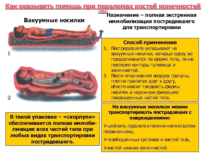 Как оказывать помощь при переломах костей конечностей (356) Вакуумные носилки Назначение – полная экстренная