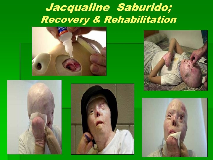 Jacqualine Saburido; Recovery & Rehabilitation 