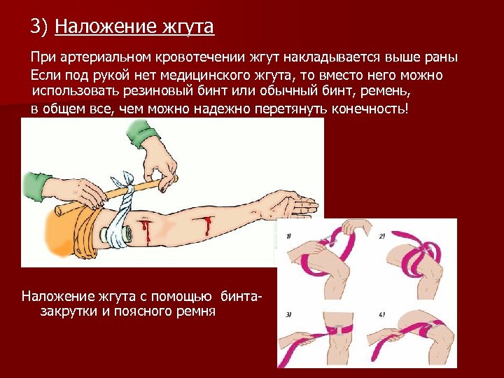 3) Наложение жгута 3) При артериальном кровотечении жгут накладывается выше раны Если под рукой