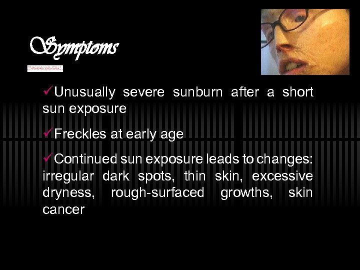 Symptoms üUnusually severe sunburn after a short sun exposure üFreckles at early age üContinued