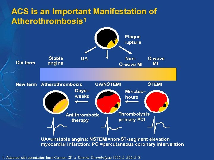 ACS is an Important Manifestation of Atherothrombosis 1 Plaque rupture Old term Stable angina