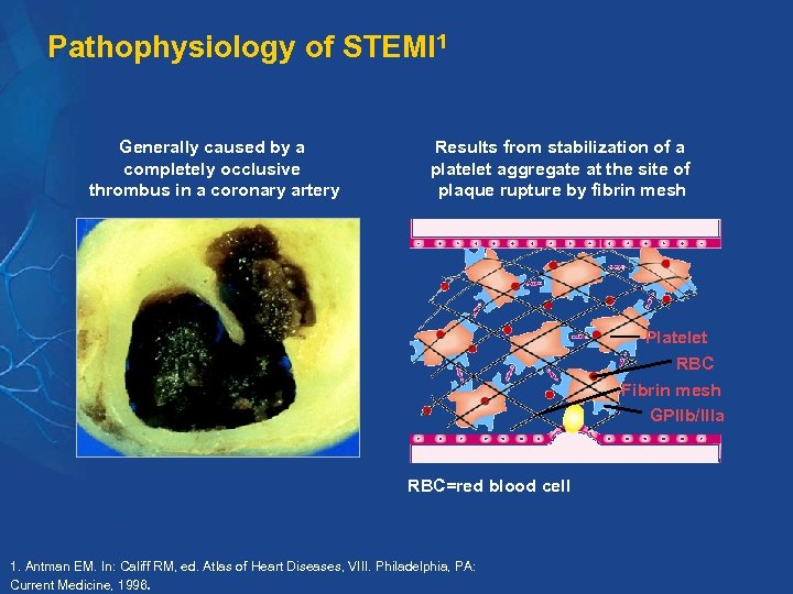 Pathophysiology of STEMI 1 Generally caused by a completely occlusive thrombus in a coronary