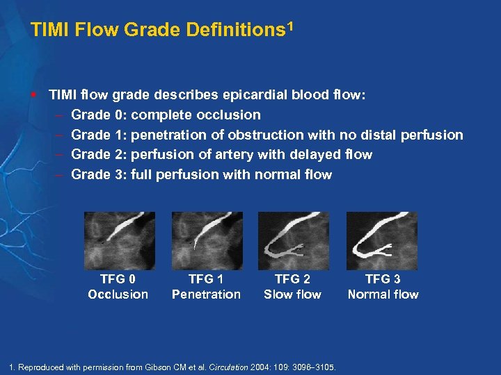 TIMI Flow Grade Definitions 1 § TIMI flow grade describes epicardial blood flow: Grade