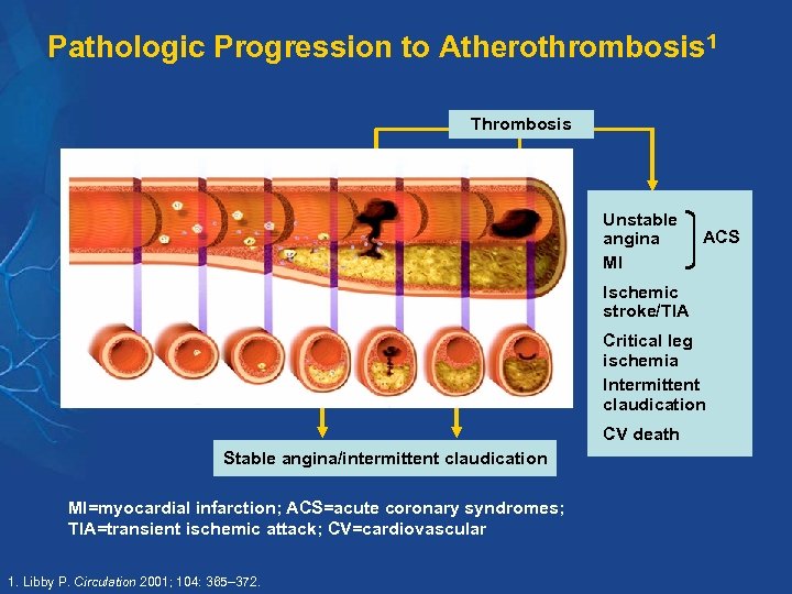 Pathologic Progression to Atherothrombosis 1 Thrombosis Unstable angina MI Atherosclerosis ACS Ischemic stroke/TIA Critical