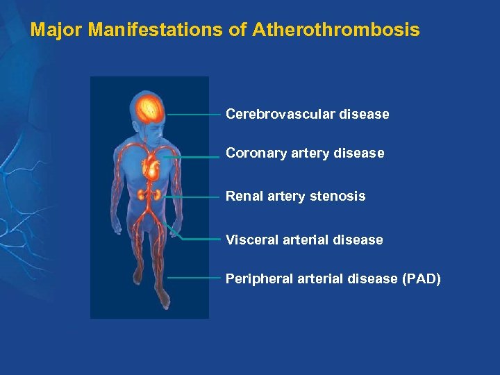 Major Manifestations of Atherothrombosis Cerebrovascular disease Coronary artery disease Renal artery stenosis Visceral arterial