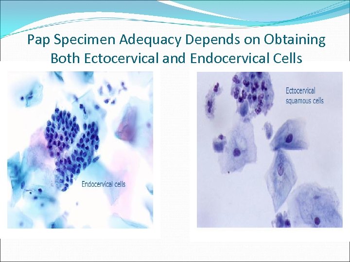 Pap Specimen Adequacy Depends on Obtaining Both Ectocervical and Endocervical Cells 