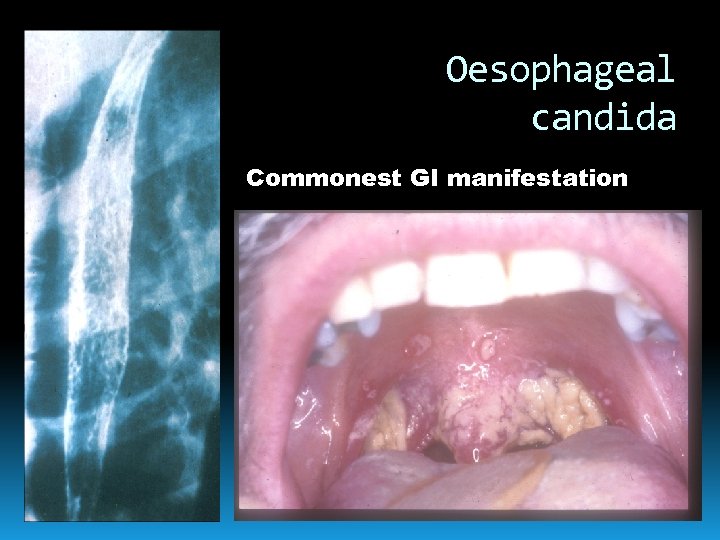 Oesophageal candida Commonest GI manifestation 