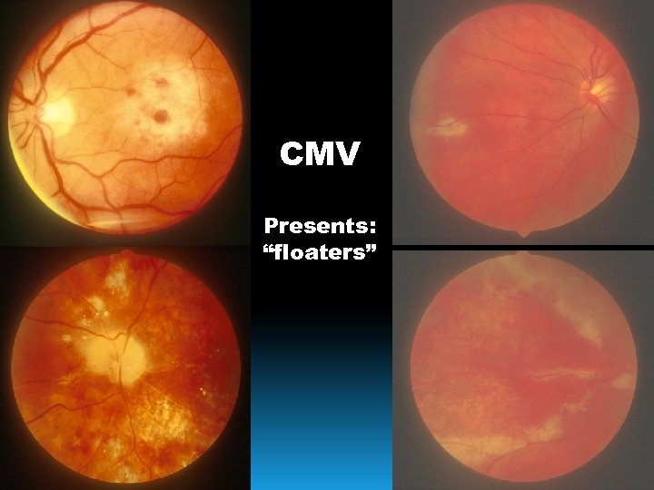 CMV Presents: “floaters” 