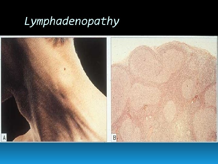Lymphadenopathy 