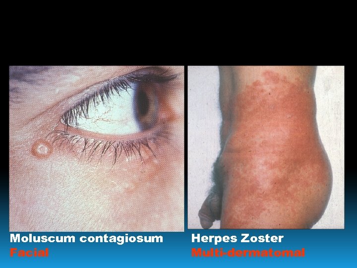 Moluscum contagiosum Facial Herpes Zoster Multi-dermatomal 