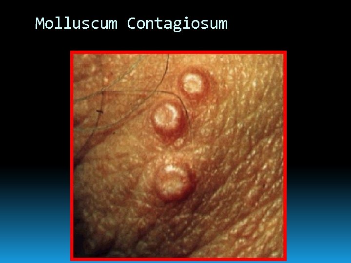 Molluscum Contagiosum 