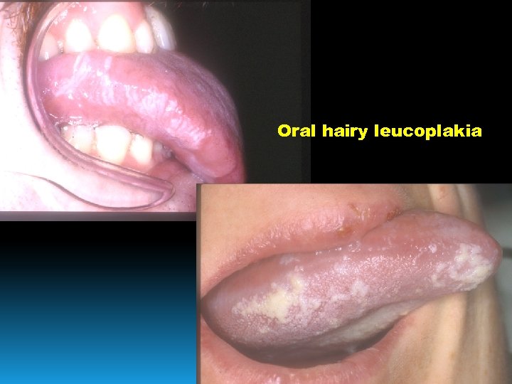 Oral hairy leucoplakia 