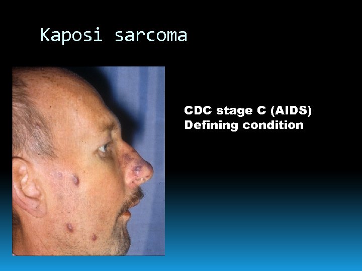 Kaposi sarcoma CDC stage C (AIDS) Defining condition 