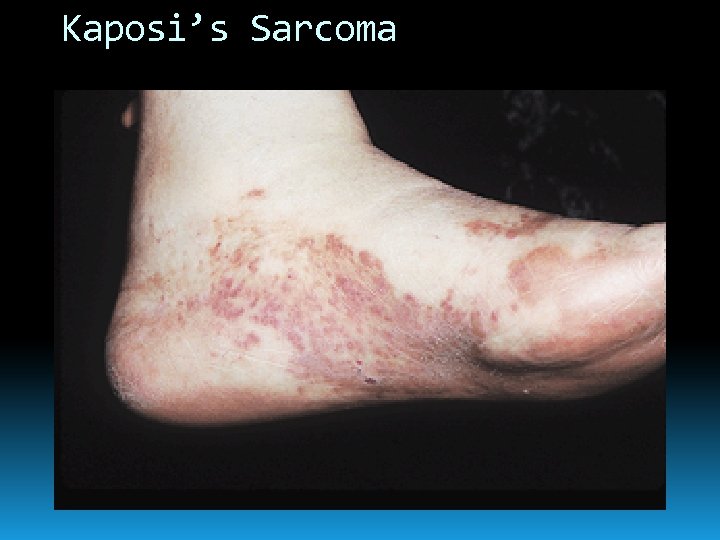 Kaposi’s Sarcoma 