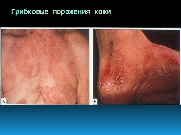Грибковые поражения кожи 