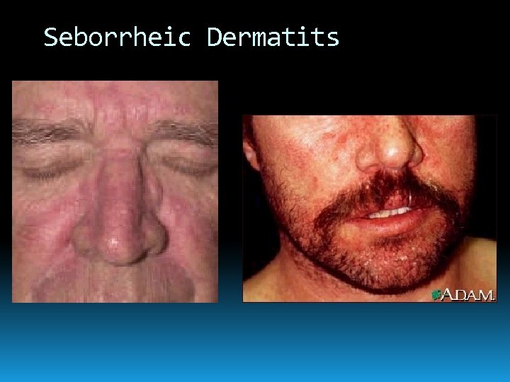 Seborrheic Dermatits 