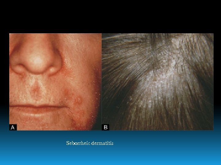 Seborrheic dermatitis 
