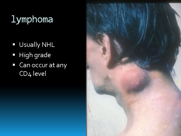 lymphoma Usually NHL High grade Can occur at any CD 4 level 