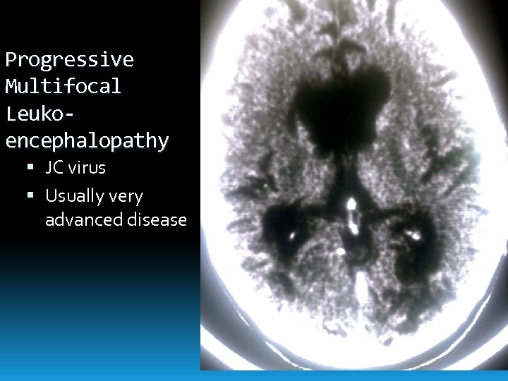 Progressive Multifocal Leukoencephalopathy JC virus Usually very advanced disease 