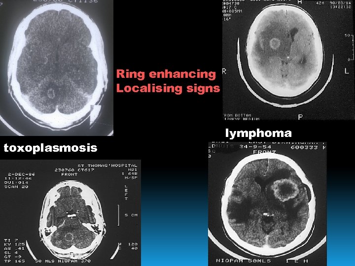 CNS Ring enhancing Localising signs toxoplasmosis lymphoma 