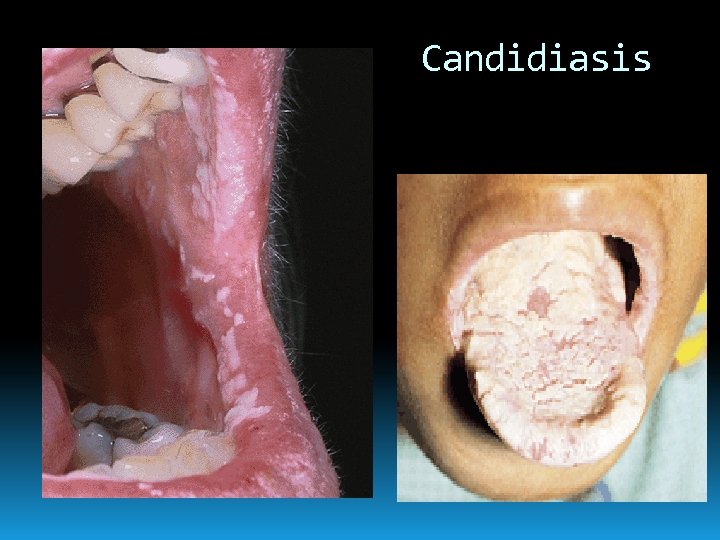 Candidiasis 