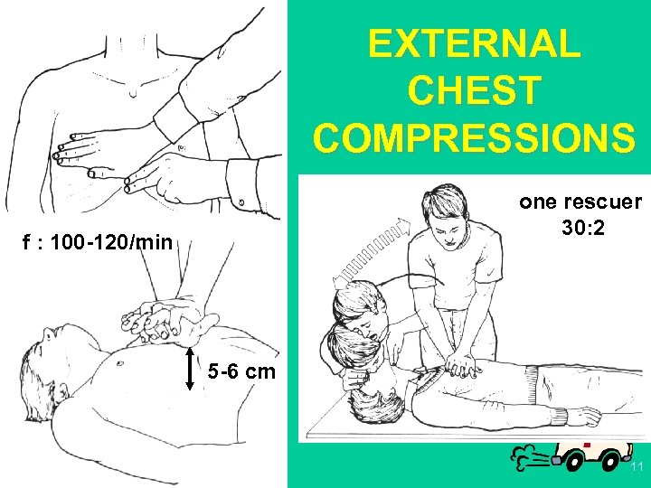EXTERNAL CHEST COMPRESSIONS one rescuer 30: 2 f : 100 -120/min. 5 -6 cm