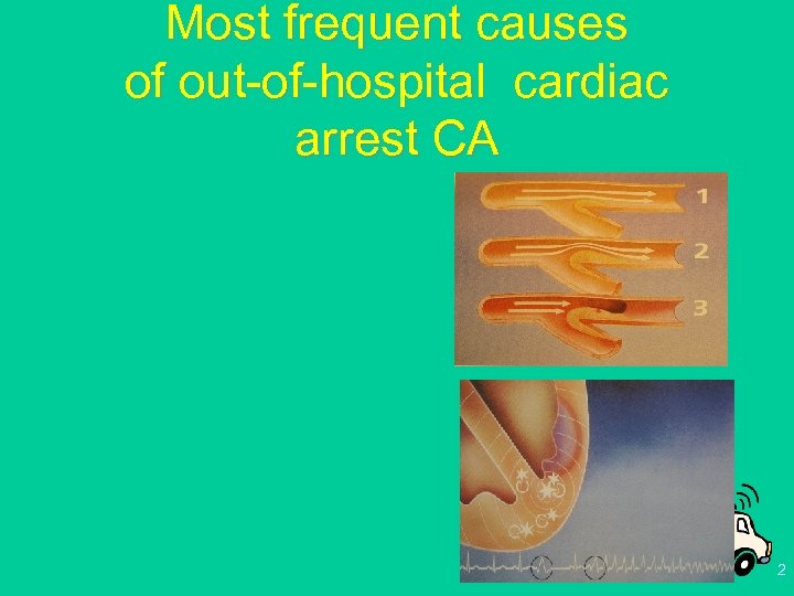 Most frequent causes of out-of-hospital cardiac arrest CA 2 
