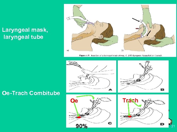 Laryngeal mask, laryngeal tube Oe-Trach Combitube Oe 90% Trach 21 