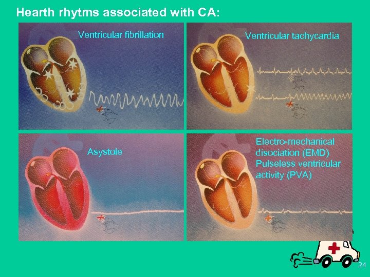 Hearth rhytms associated with CA: Ventricular fibrillation Asystole Ventricular tachycardia Electro-mechanical disociation (EMD) Pulseless