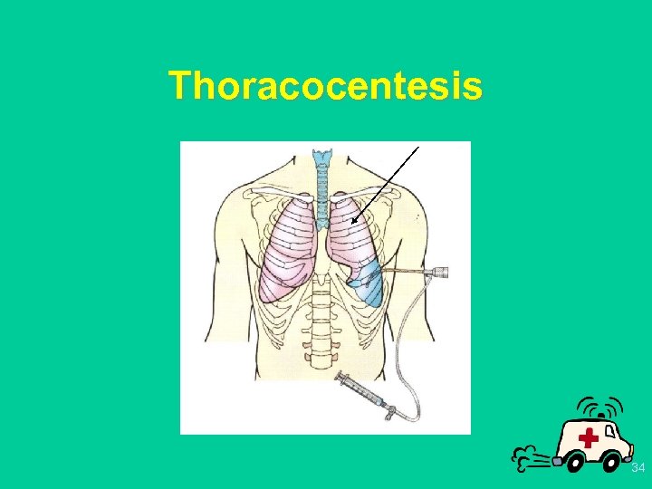 Thoracocentesis 34 