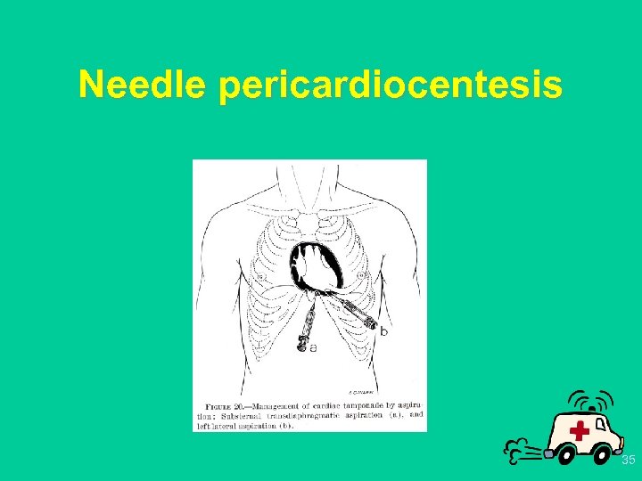 Needle pericardiocentesis 35 