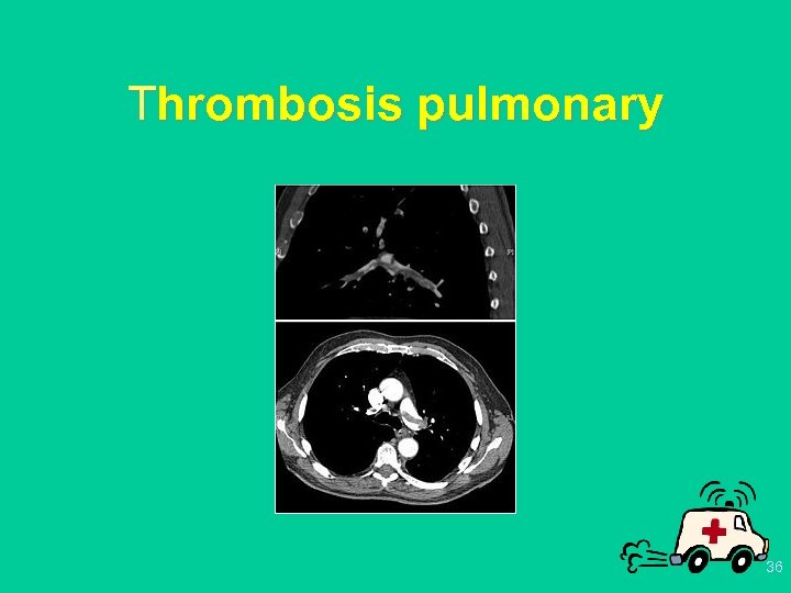 Thrombosis pulmonary 36 